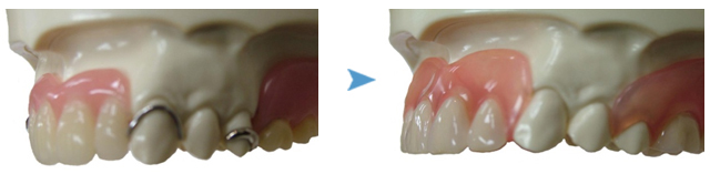 金属バネの義歯とノンクラスプ義歯の違い