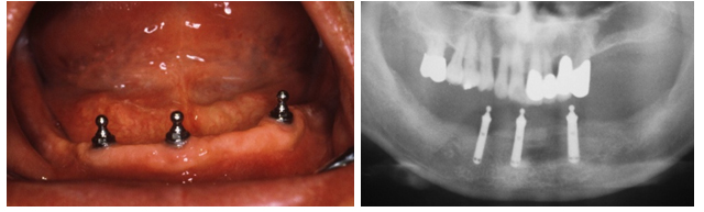 インプラント義歯を装着する口腔内画像
